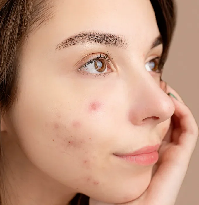 Acne Scar Treatment