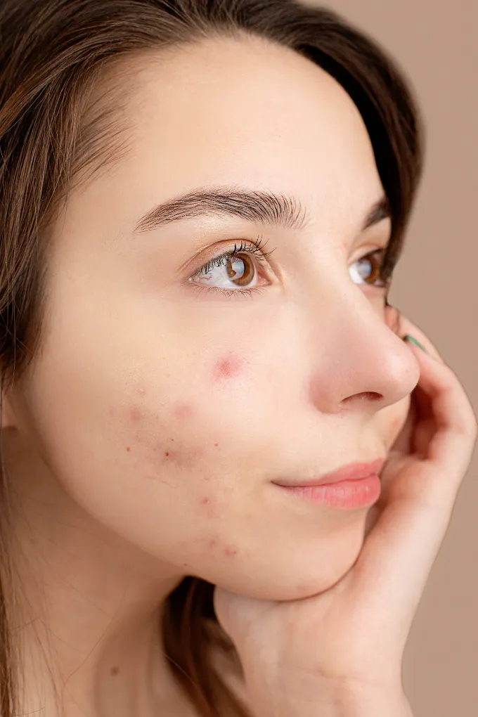 Acne Scar Treatment