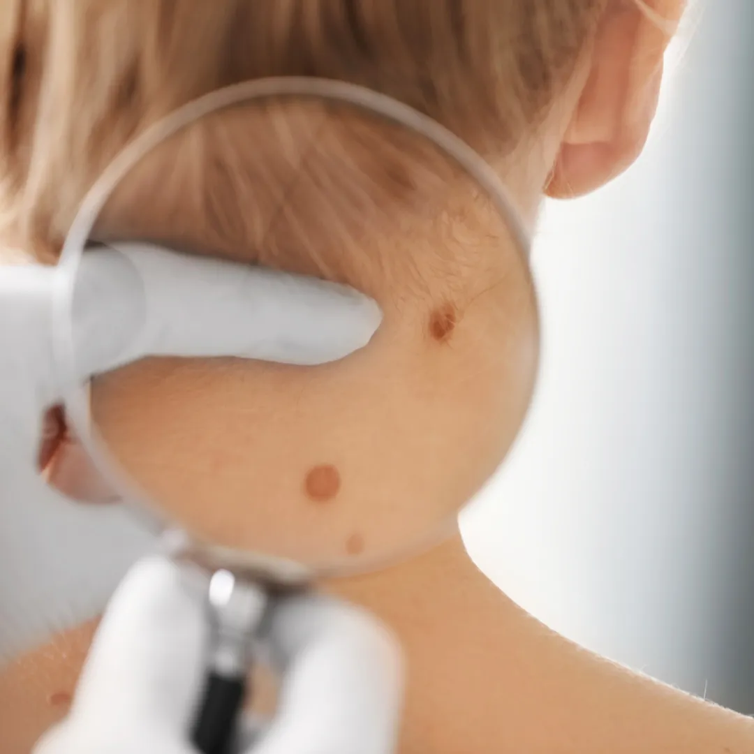 Birthmarks