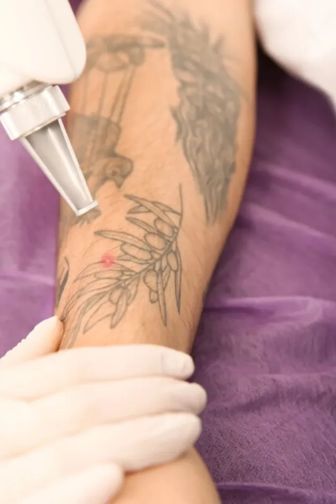 Laser Tattoo Removal