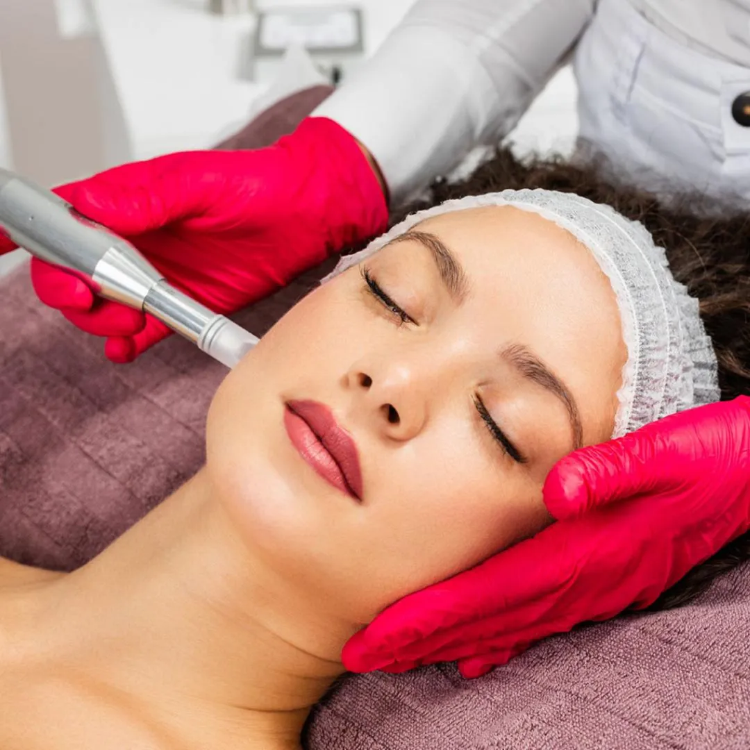 Microneedling Acne Scar Treatment Coimbatore