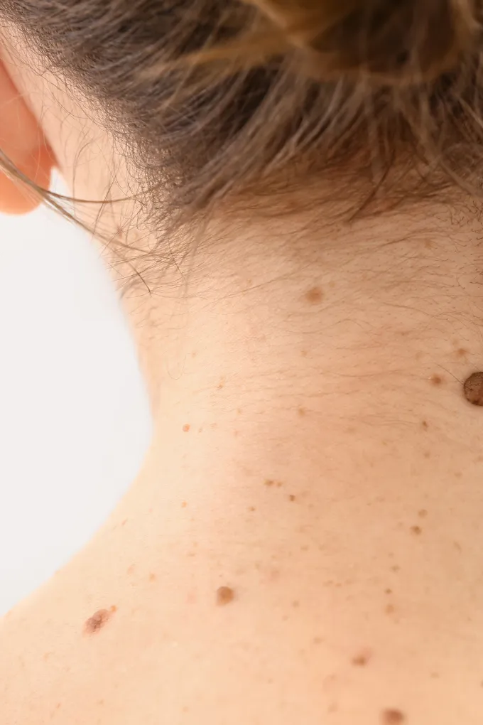 Mole and Wart 1
