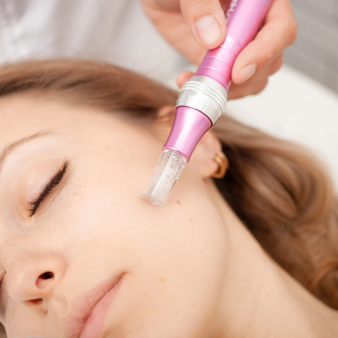 Precision Microneedling for Scar Revision