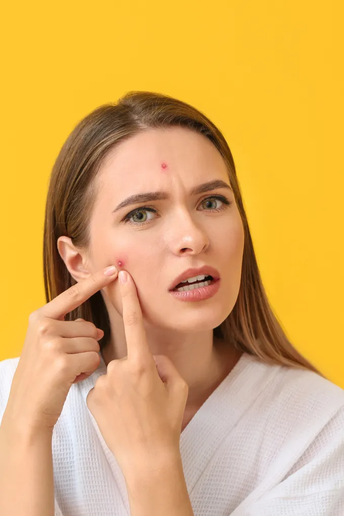 Acne and Pimple Treatment