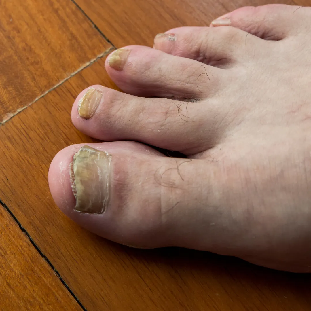 Nail Fungal Infections