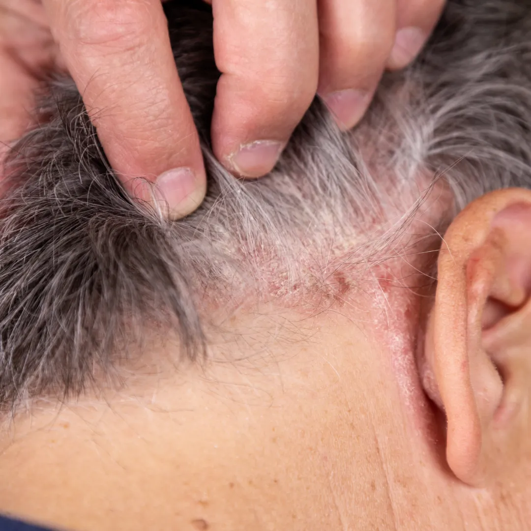 Psoriasis