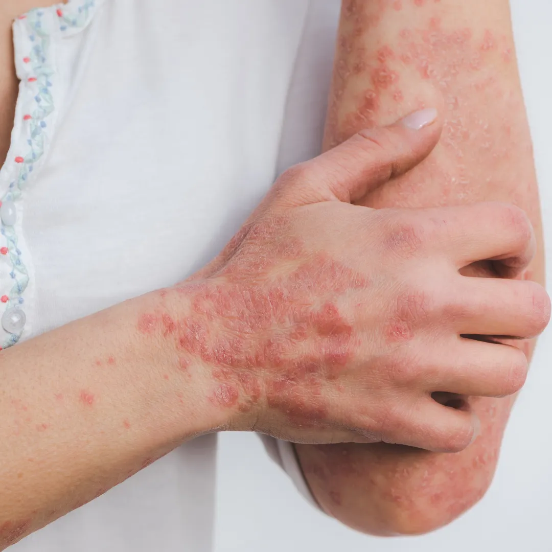 Psoriasis