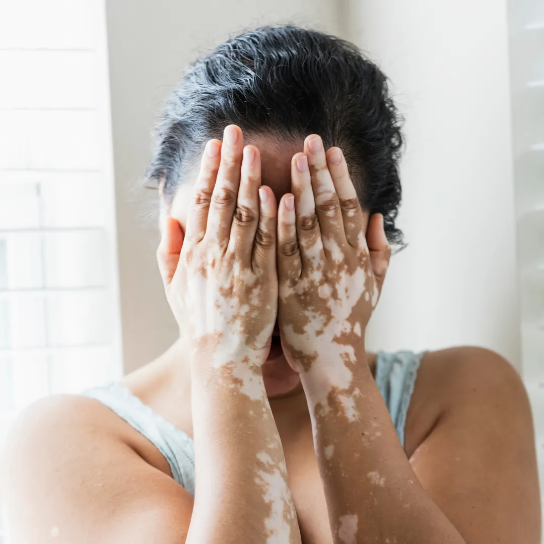 PUVA Treatment