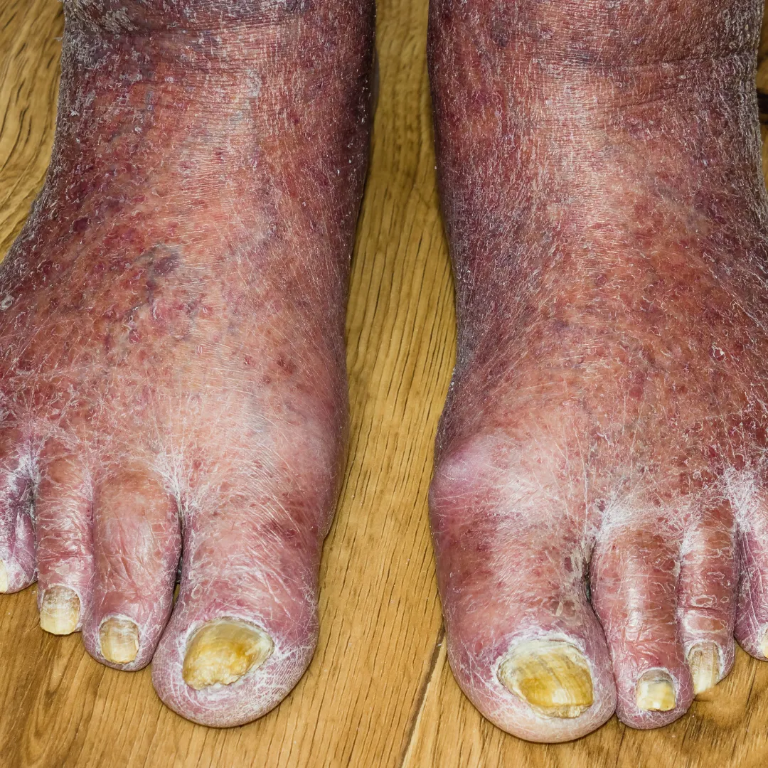 Athlete’s Foot
