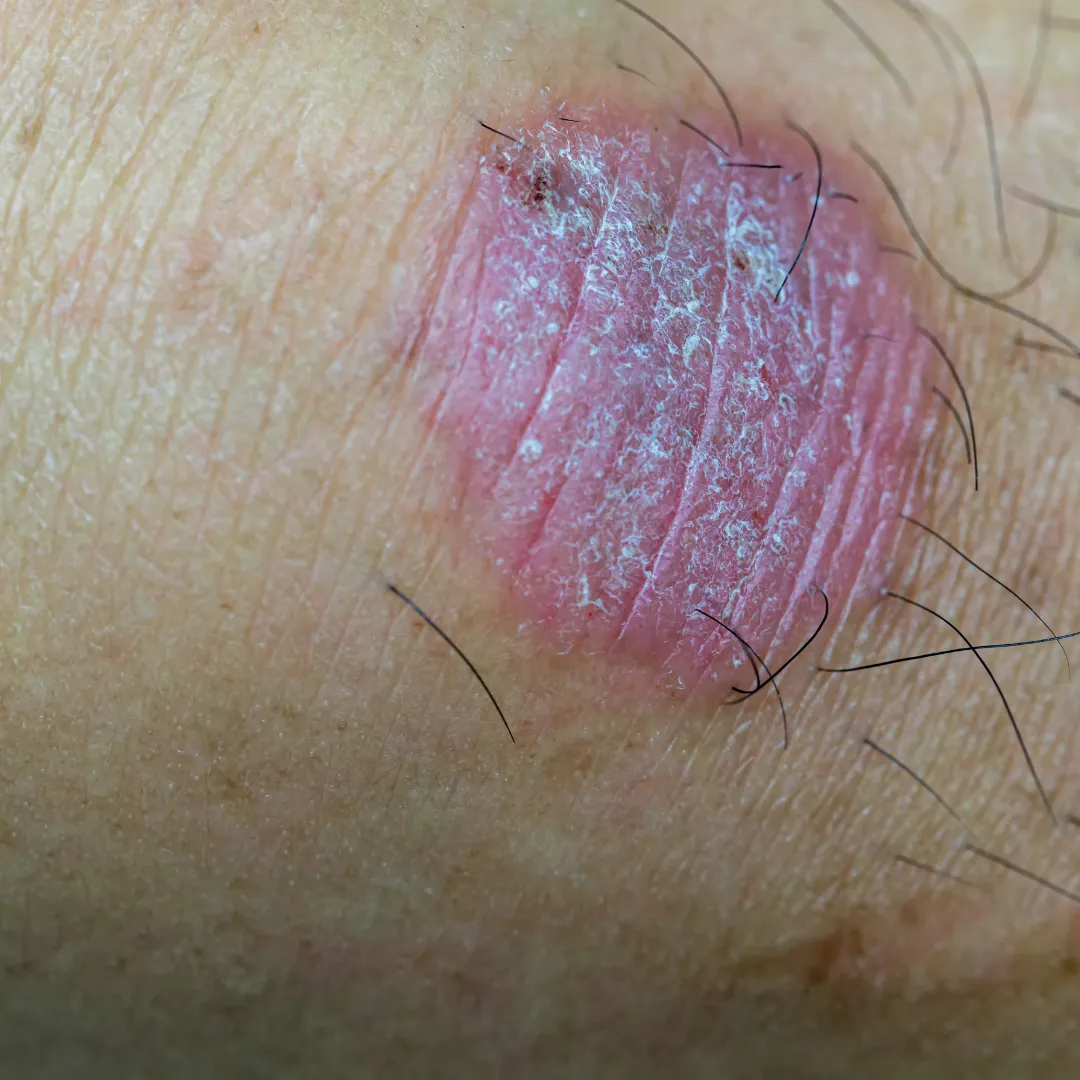 Ringworm