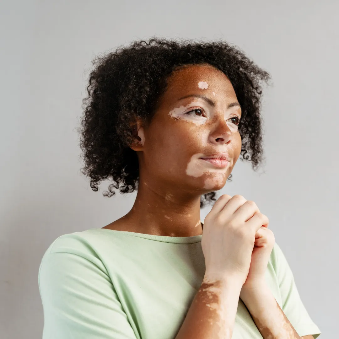 Skin Grafting for Vitiligo