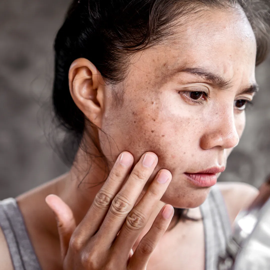 Lichen Planus Pigmentosus Treatment