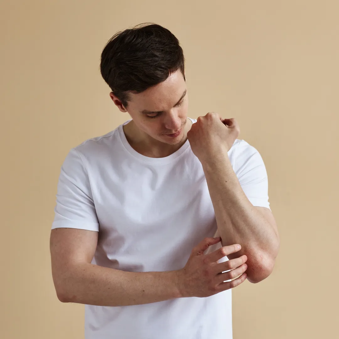 Psoriasis