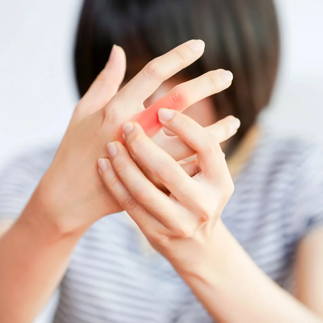 Psoriasis