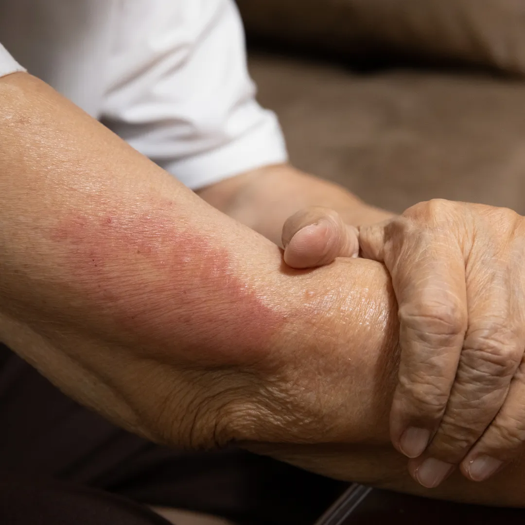 Dryness, Rashes, and Itching in Old People