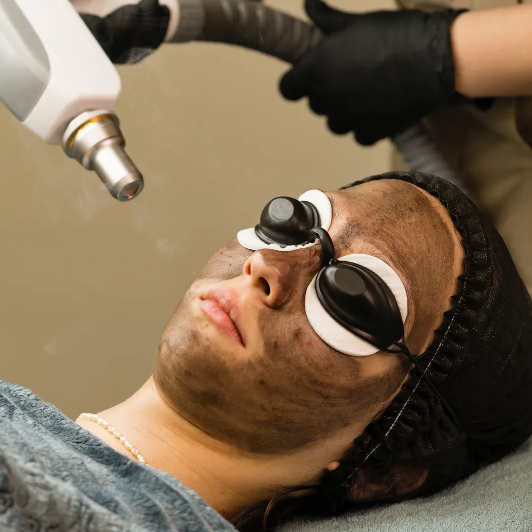 Carbon laer facial