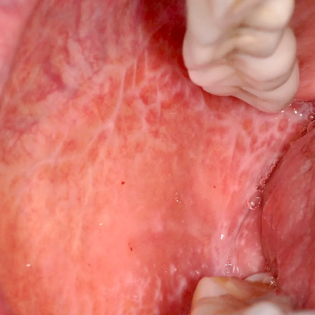 Oral Lichen Planus Treatment