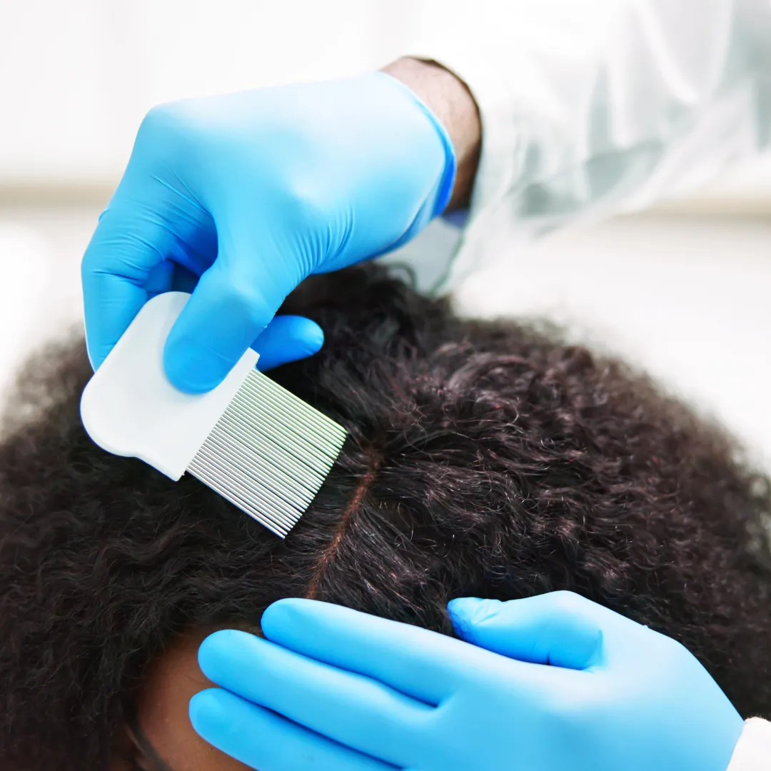 Scalp Psoriasis Treatment