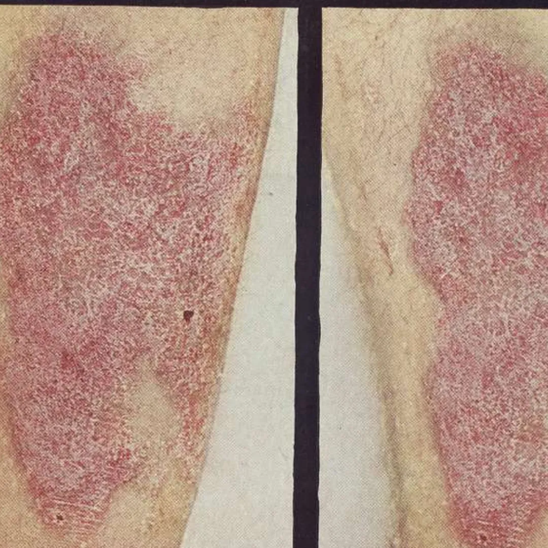 Skin Lichen Planus Treatment