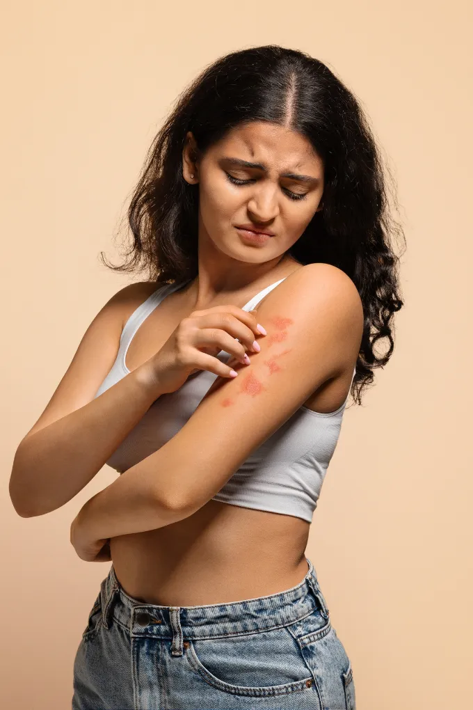 Psoriasis Treatment in Coimbatore