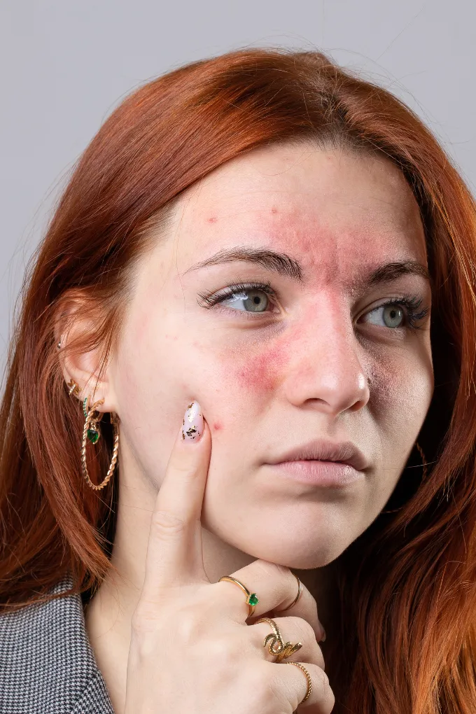 Eczema Treatment In Coimbatore