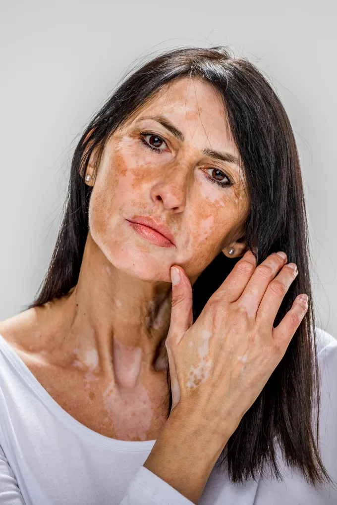 Vitiligo Treatment in Coimbatore