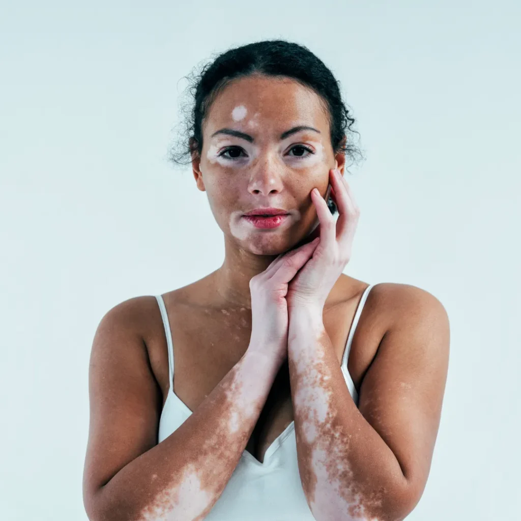Vitiligo Treatment