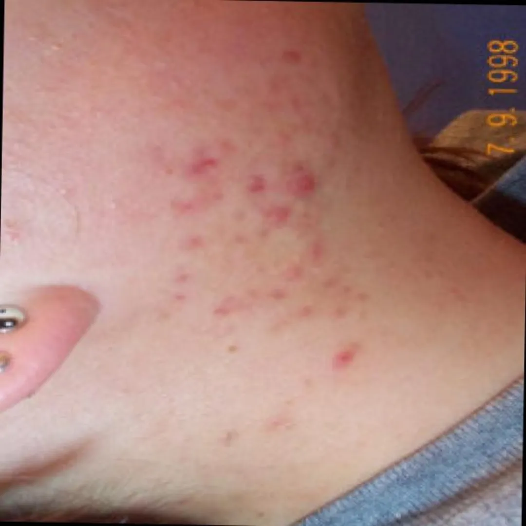 Lichen Planus Treatment