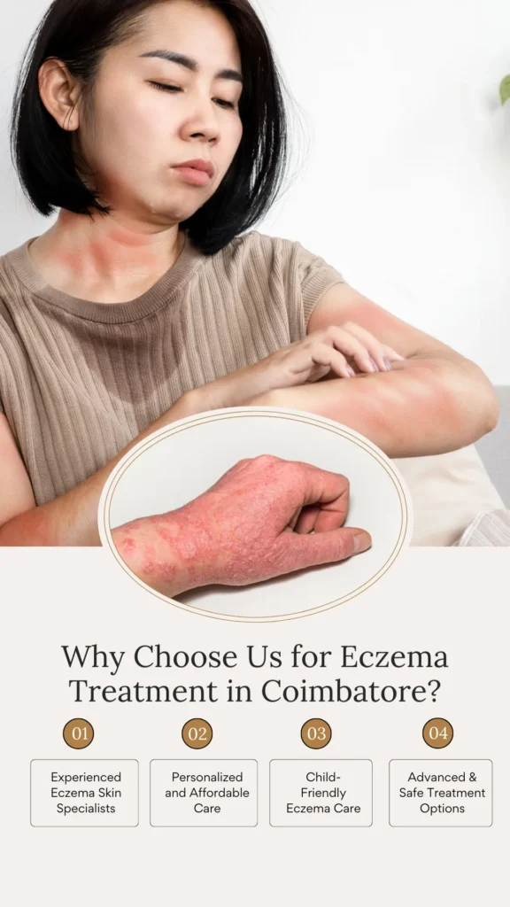 Why Choose Us for Eczema Treatment in Coimbatore