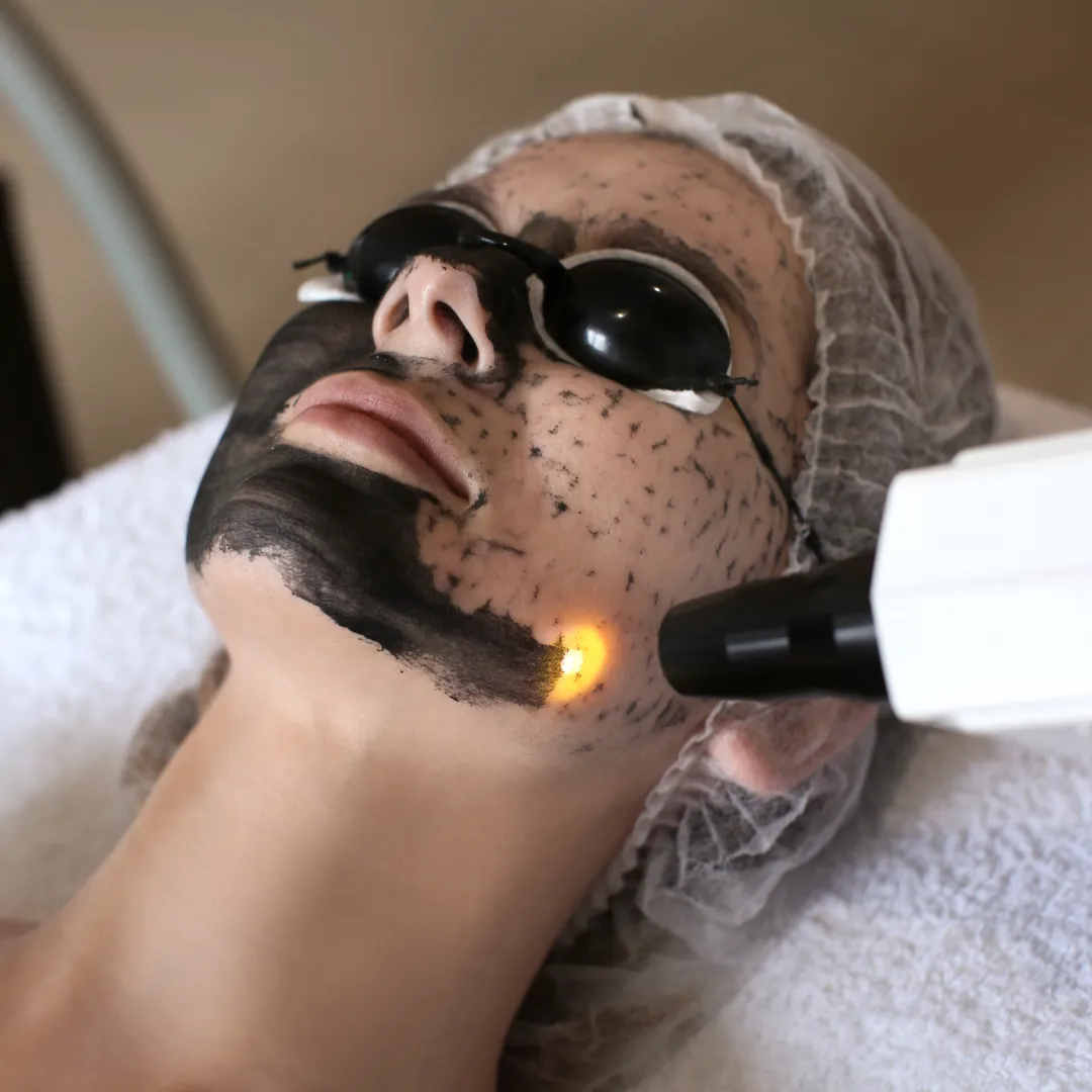 carbon laser Facial