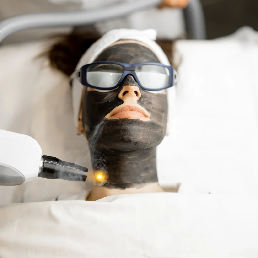 Carbon Laser Facial for Melasma and Dark Spot