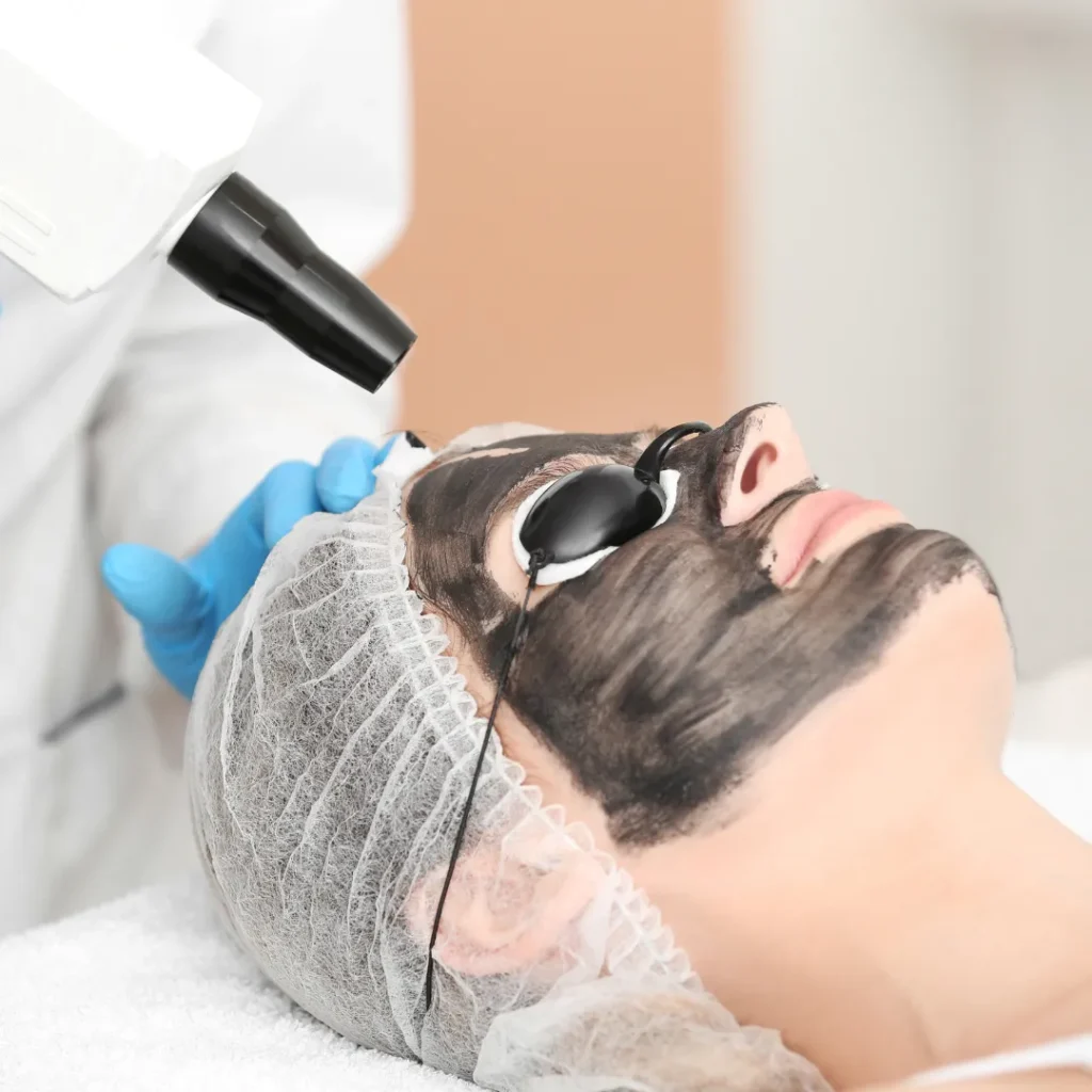 Carbon Laser Facial Results