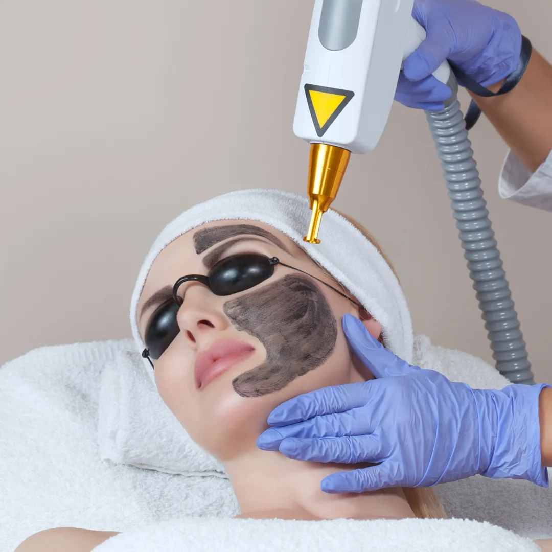 Carbon Laser Facial for Acne Scars in Coimbatore