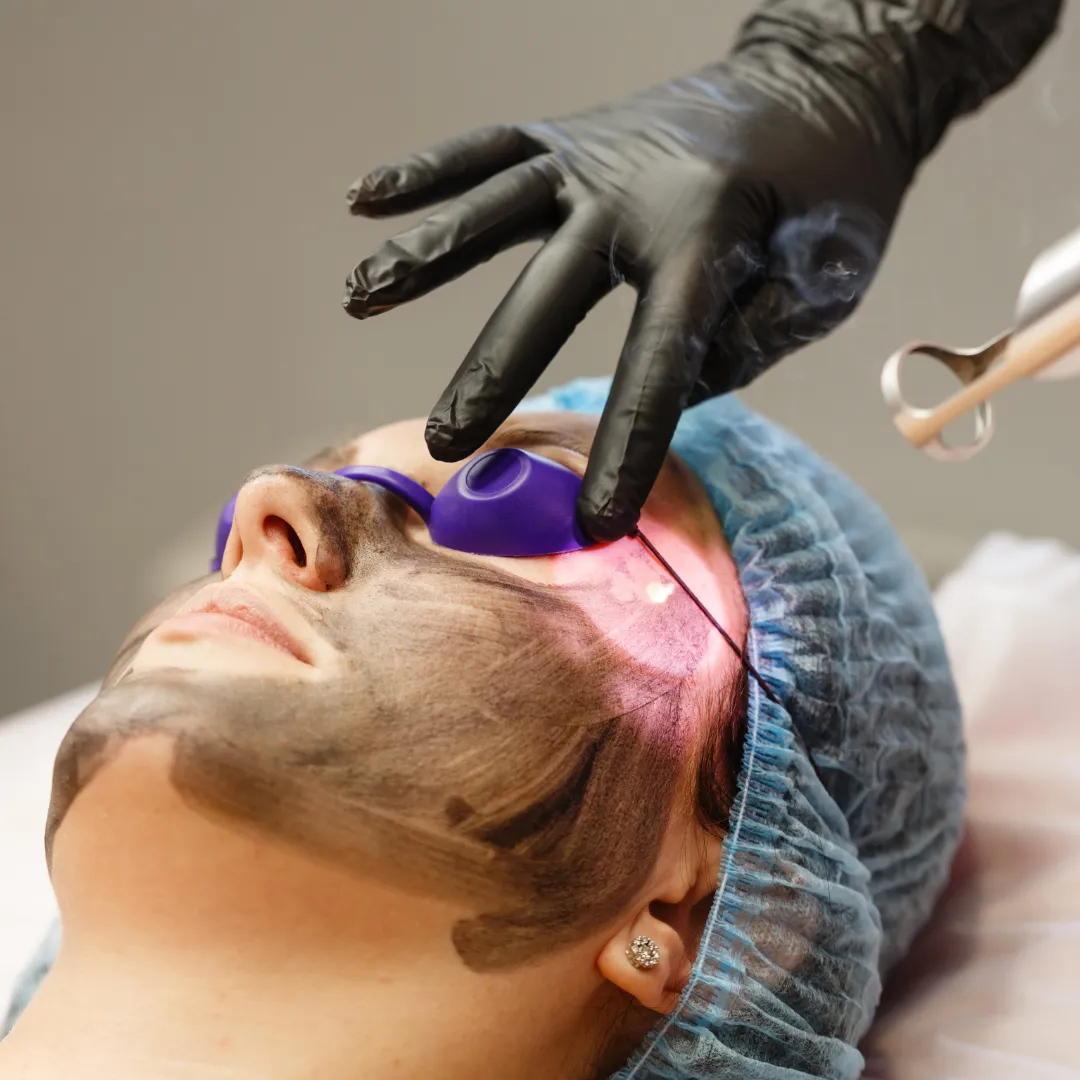 Carbon Laser Facial for Uneven Skin Tone
