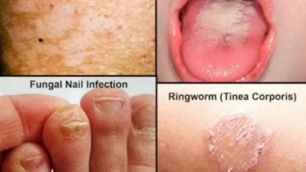 types of fungal infections
