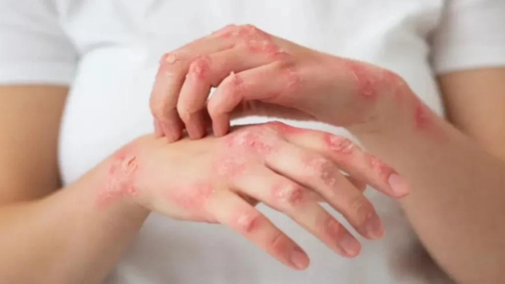 Professional scabies treatment clinic Coimbatore