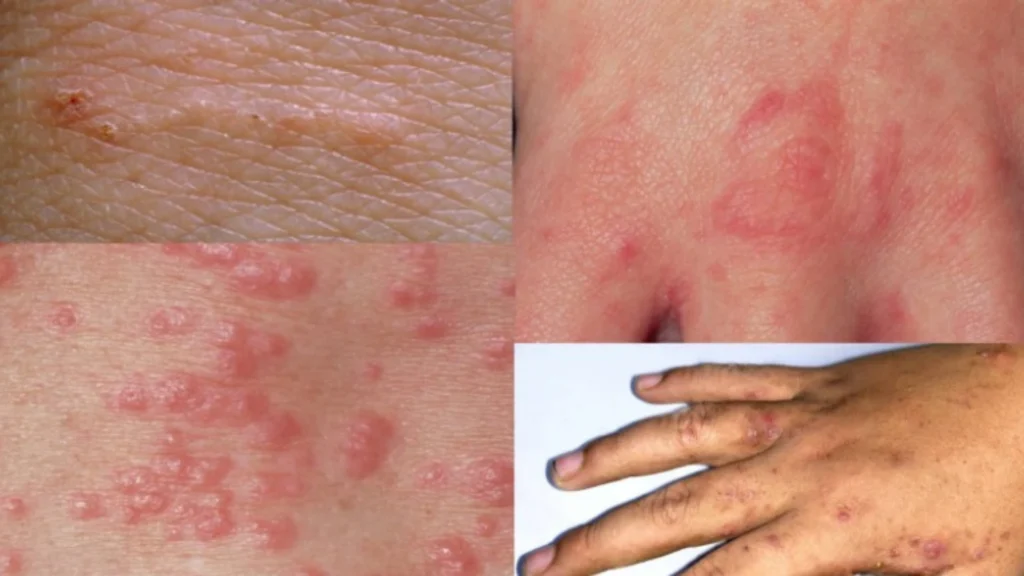Best scabies treatment in Coimbatore