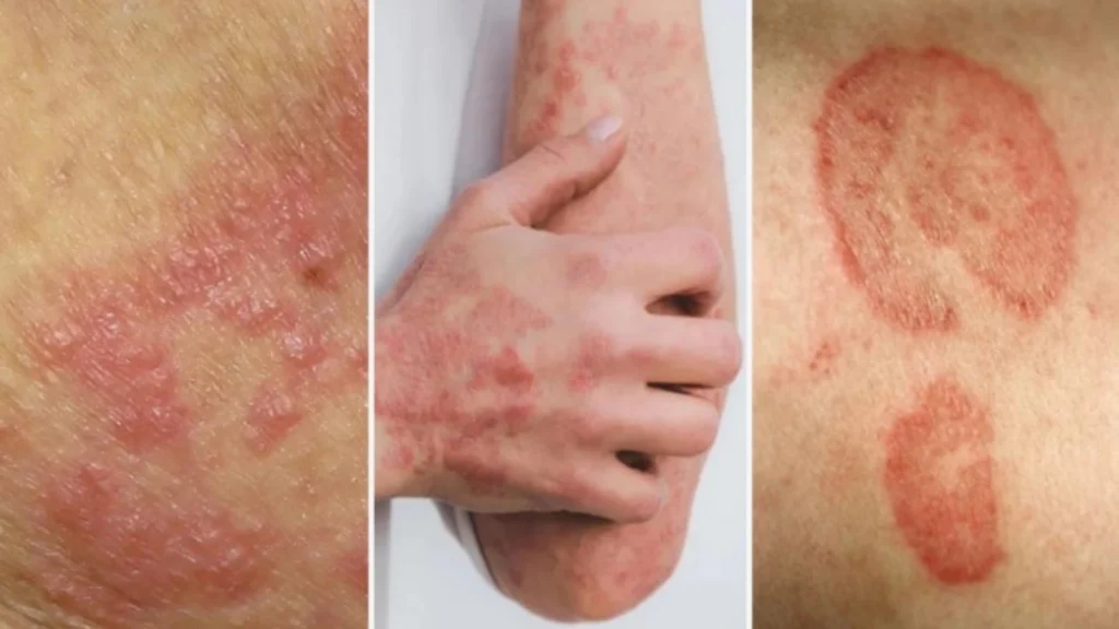 best fungal treatment in Coimbatore