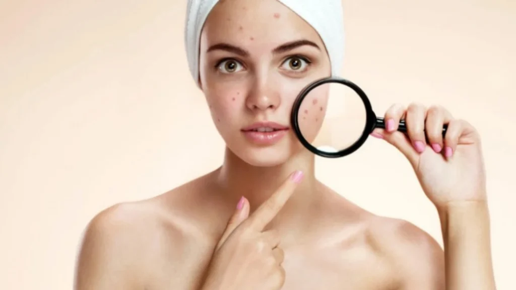 Acne treatment in Coimbatore