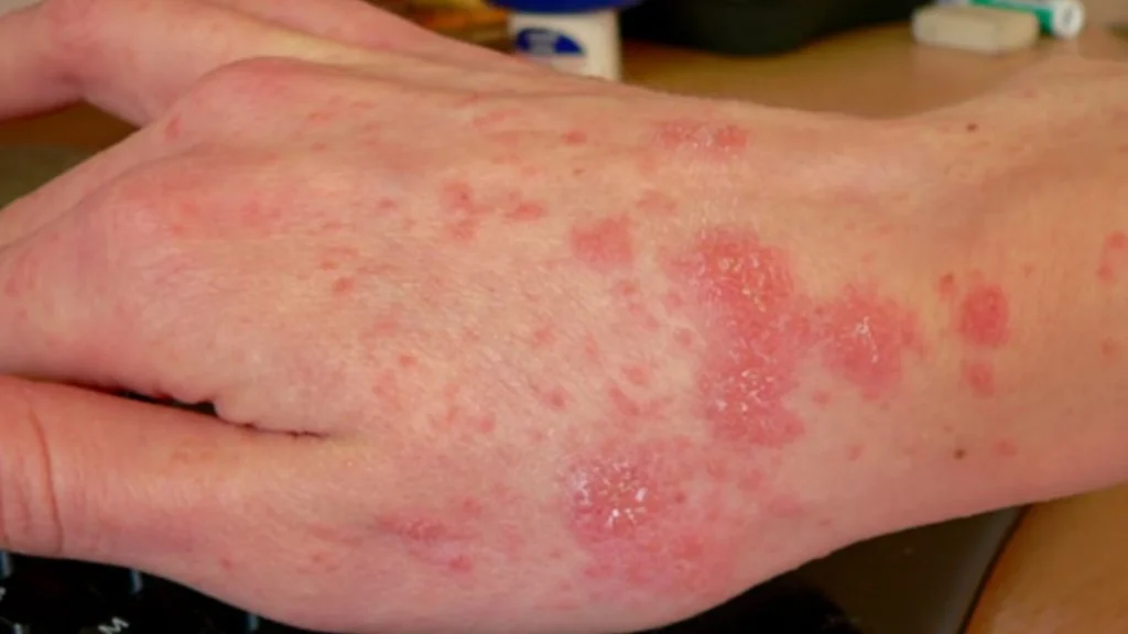 Best scabies treatment in Coimbatore