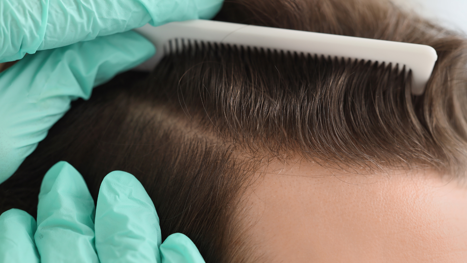 Best Hair Thinning Treatment in Coimbatore