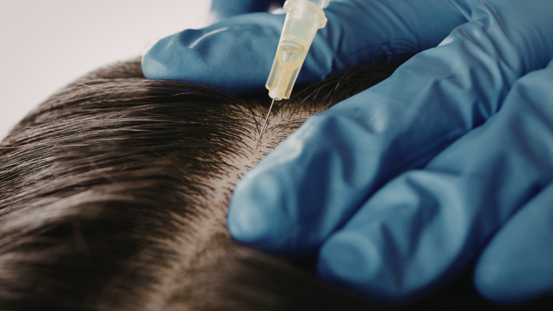 PRP Hair Treatment in Coimbatore
