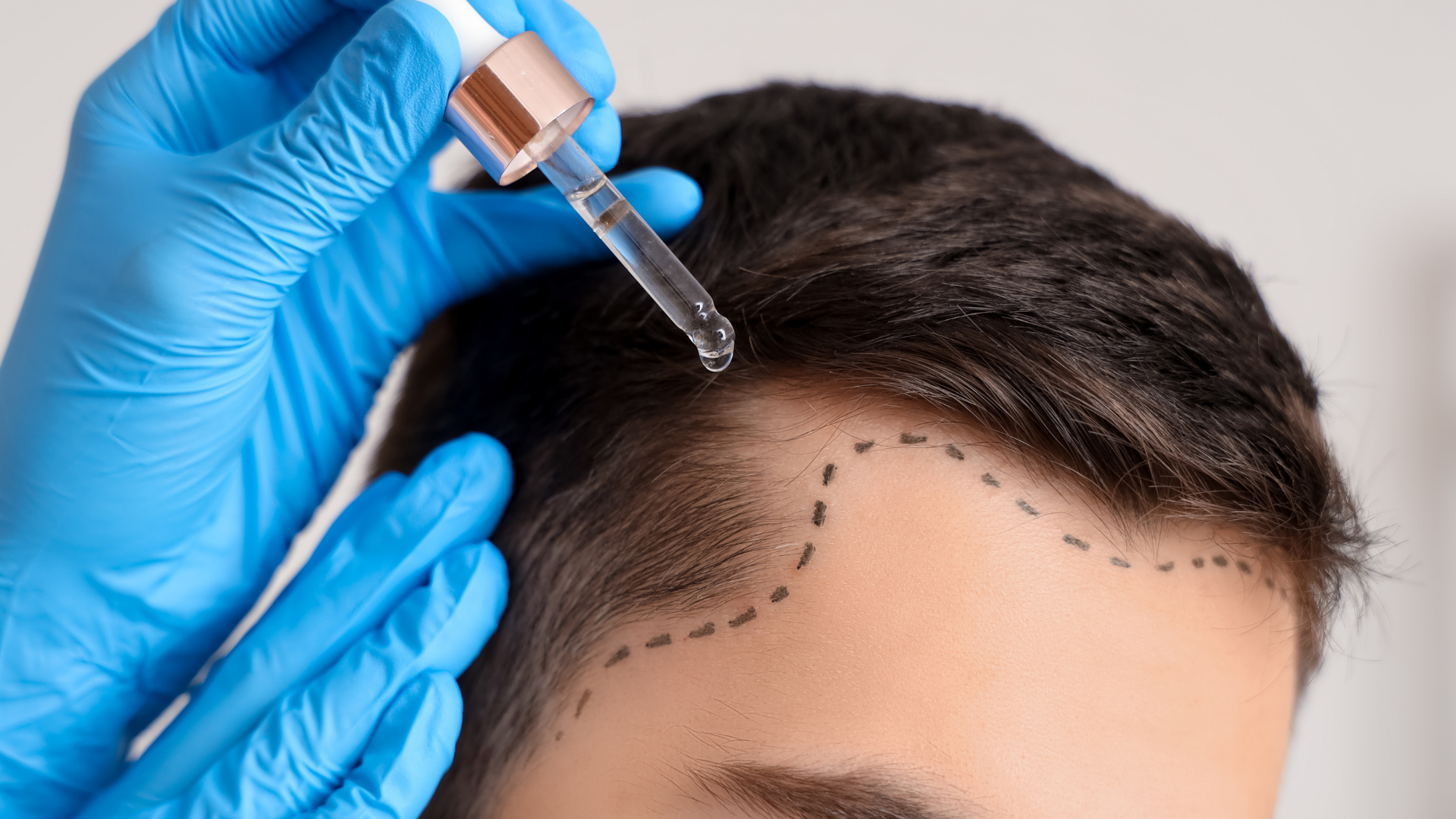 Best PRP Hair Treatment in Coimbatore