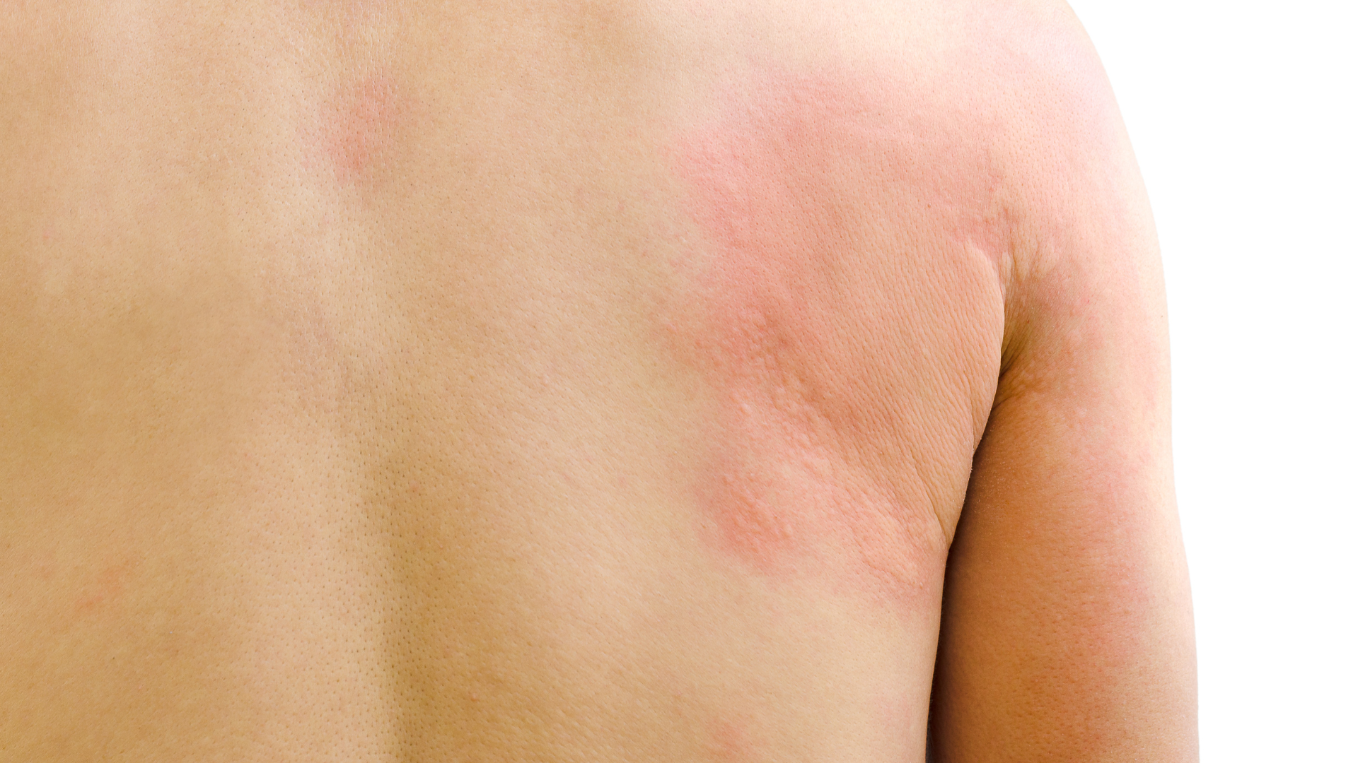 Urticaria Treatment in Coimbatore