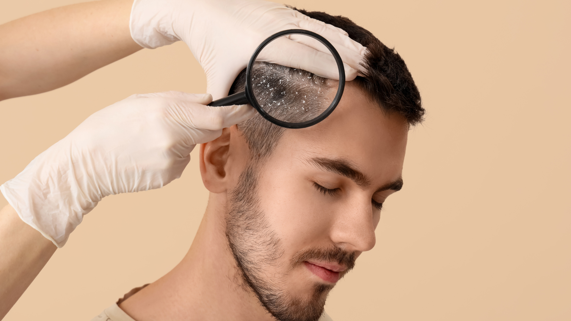 Best Dandruff Treatment 